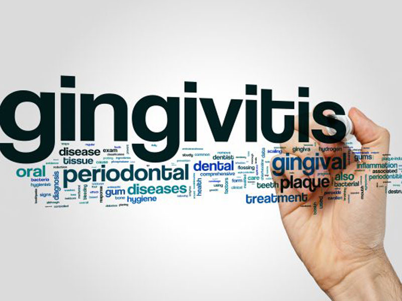 What Is Gingivitis? featured image
