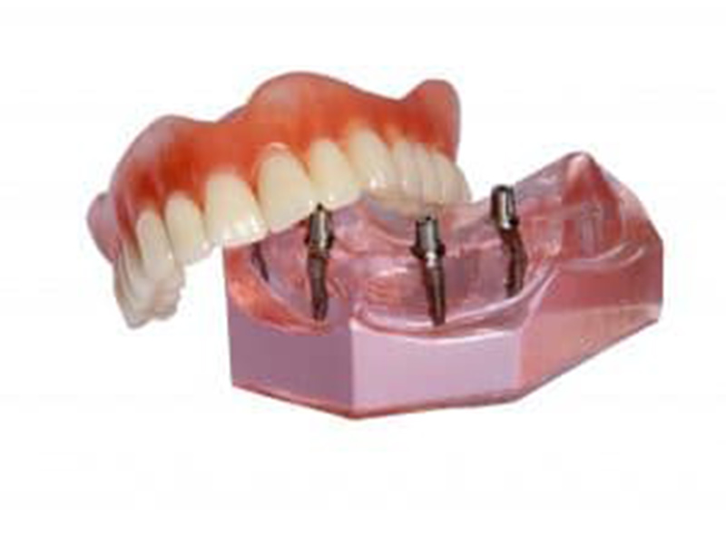 Interested in Same Day Dental Implants? featured image