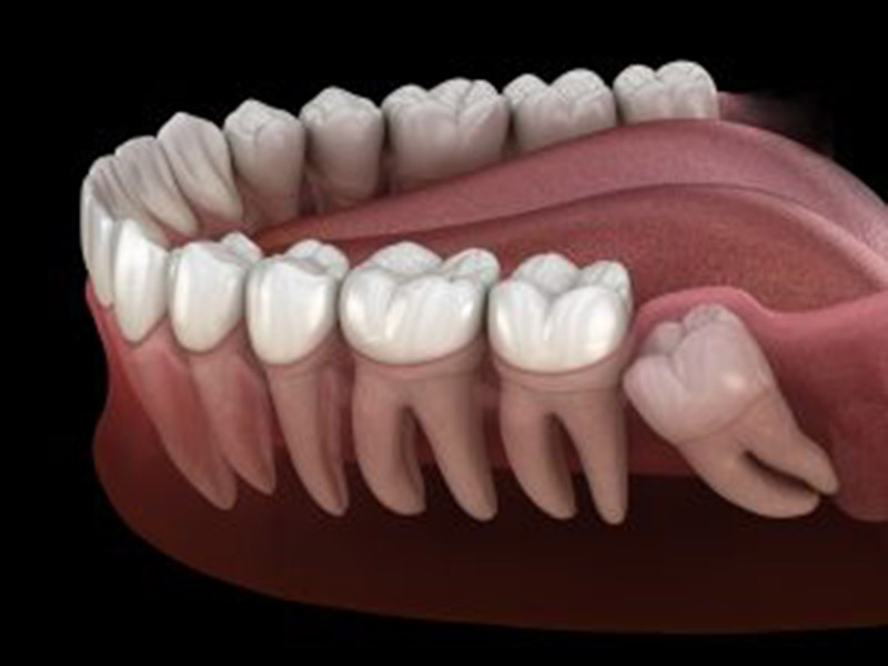 Do I Need My Wisdom Teeth Removed? featured image