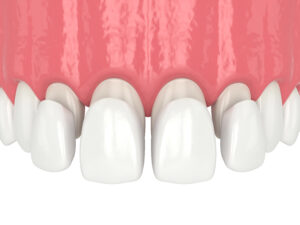3d render of upper jaw with four veneers over white