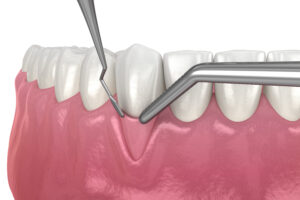 Gum Grafting: What Options Do You Have? featured image
