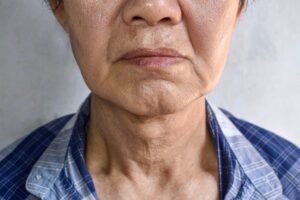 Aging skin folds or skin creases or wrinkles of Southeast Asian, Chinese old man.