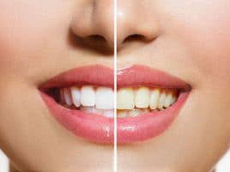 Dealing With Dental Discoloration featured image