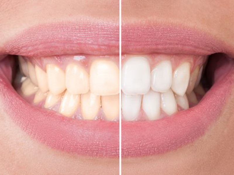Choose Your Option for a Brighter Smile featured image