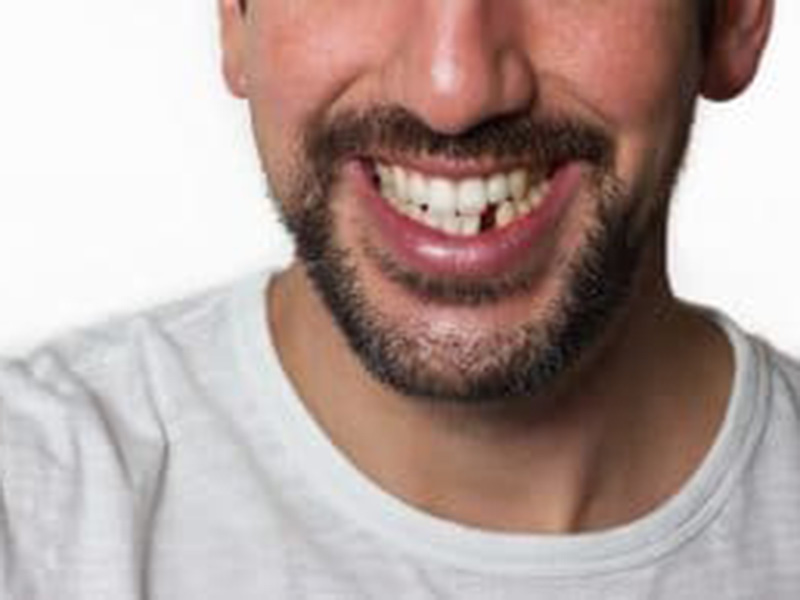 a person showing his broken teeth