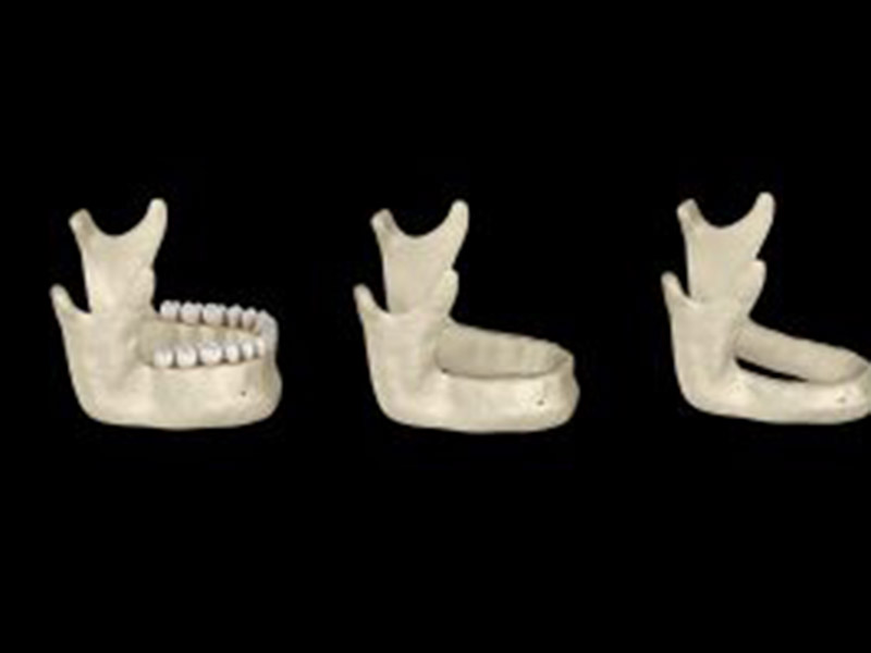 Creating a Better Smile With Jawbone Grafting featured image