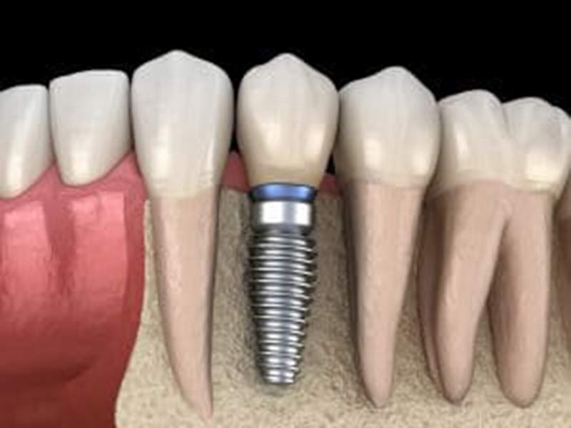 bone grafting