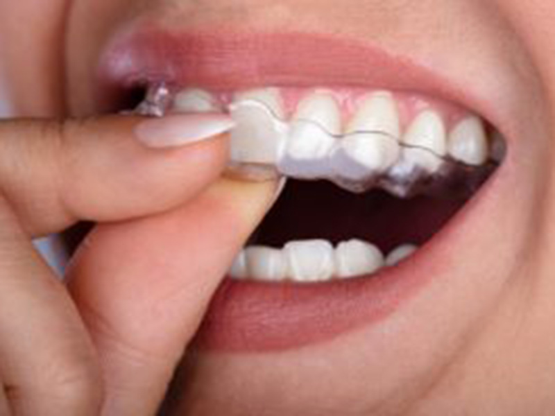 Have You Heard of Clear Braces? featured image