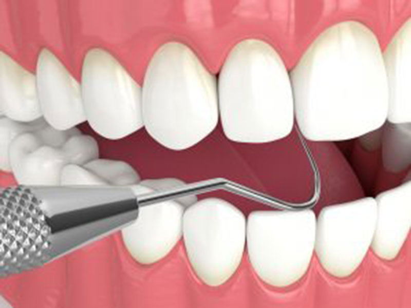 teeth treatment process