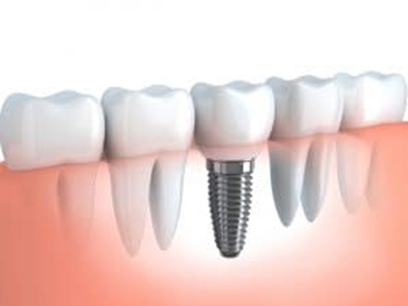 What to Expect From the Implant Placement Process featured image