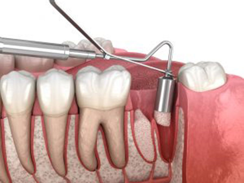 teeth extraction process
