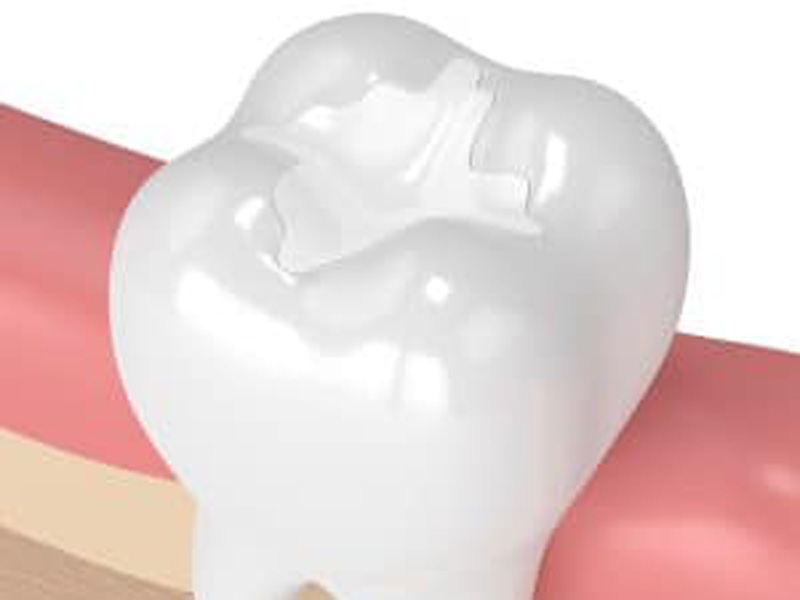 Restoring Decayed Tooth Structure With Fillings featured image
