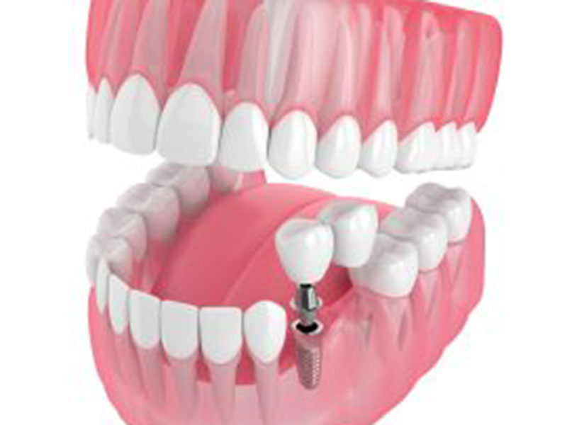 Could Dental Bridges Be Supported With Implants? featured image