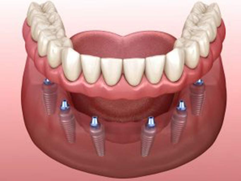 denture implant