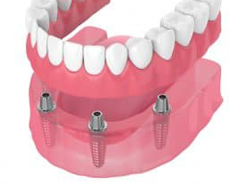 Supporting Dentures With Dental Implants featured image