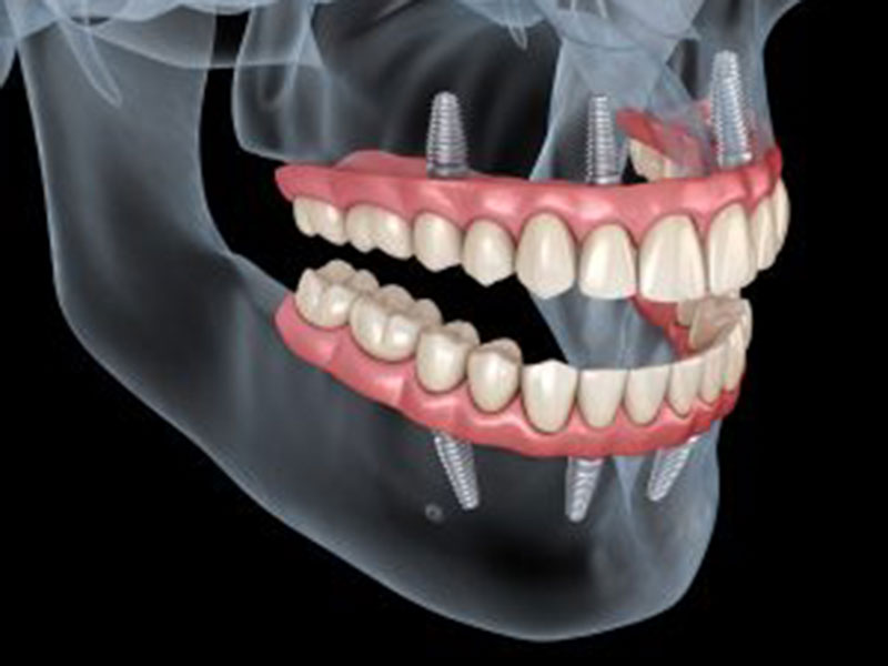 Could Dental Implants Support Dentures? featured image