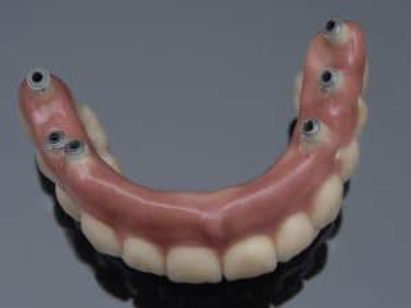 implant dentures