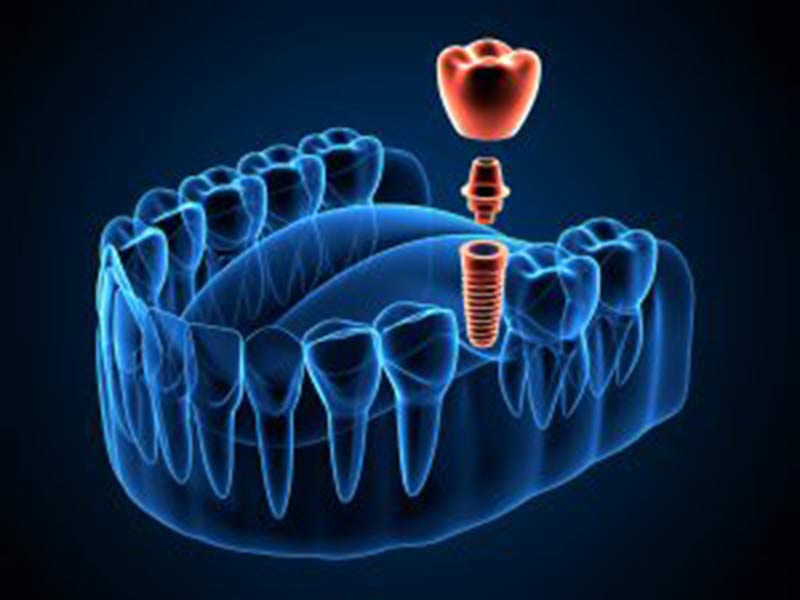 sedation oral surgery