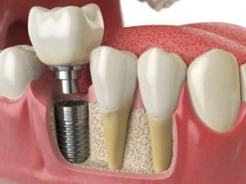 When Does a Patient Need Oral Surgery? featured image