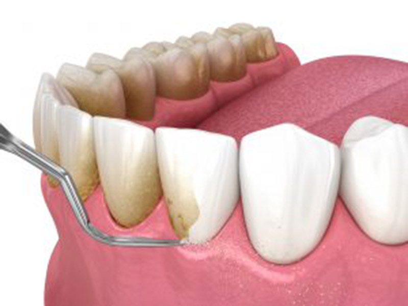 Periodontal Treatment for Poor Gum Health featured image