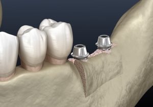 tooth implant in the mouth