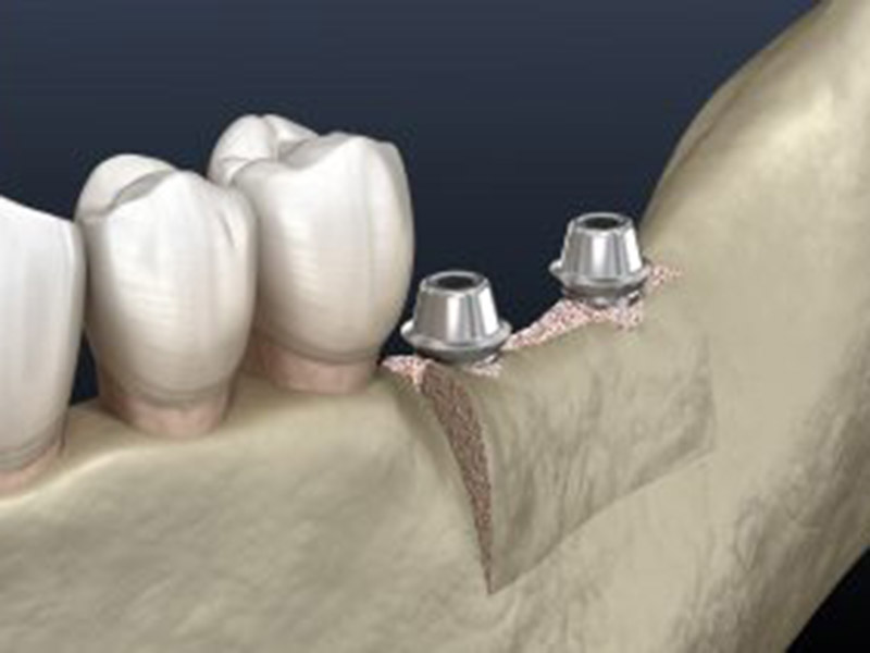 How We Place Your Dental Implants featured image