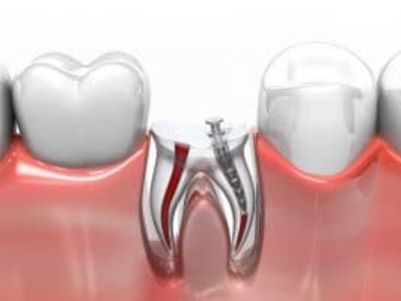 When to See Us for a Root Canal featured image