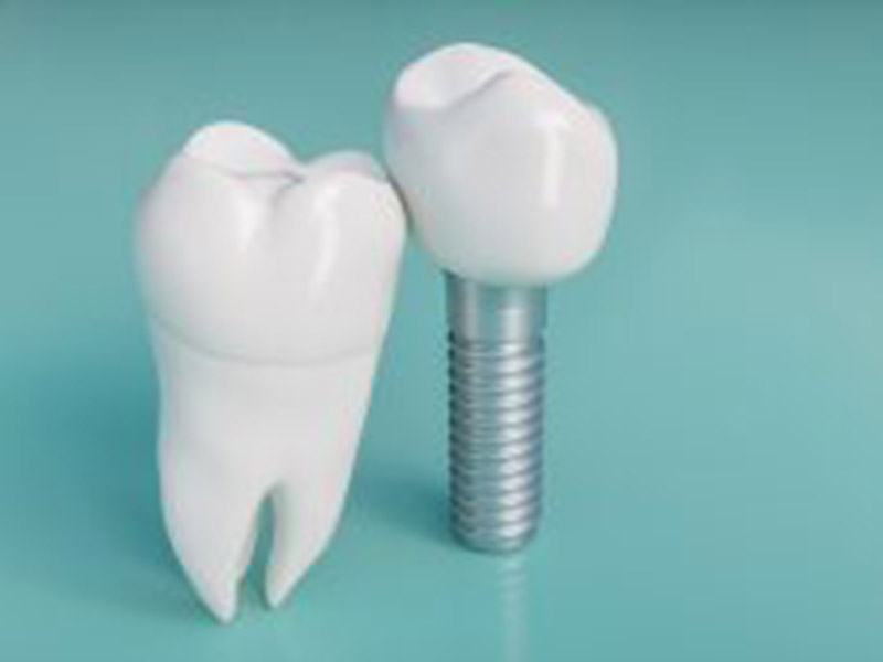 Could We Place Your Implants Same-Day? featured image