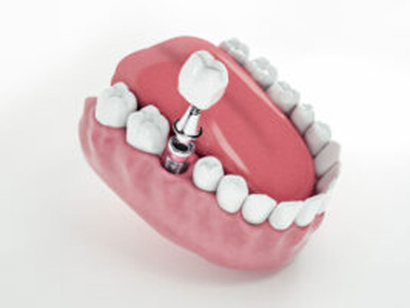Placing Your Dental Implants Same-Day featured image