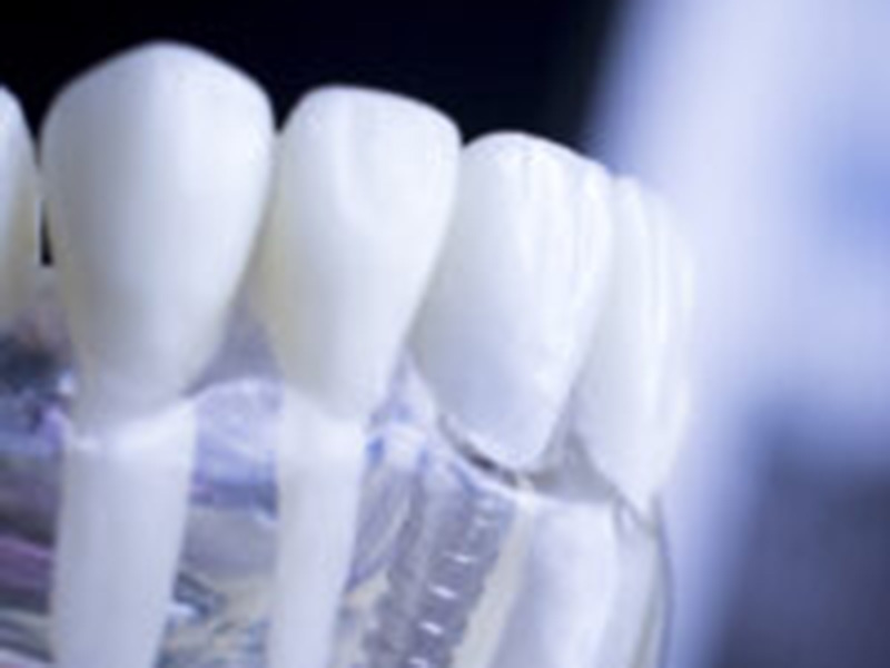 How Your Smile Supports Dental Implants featured image