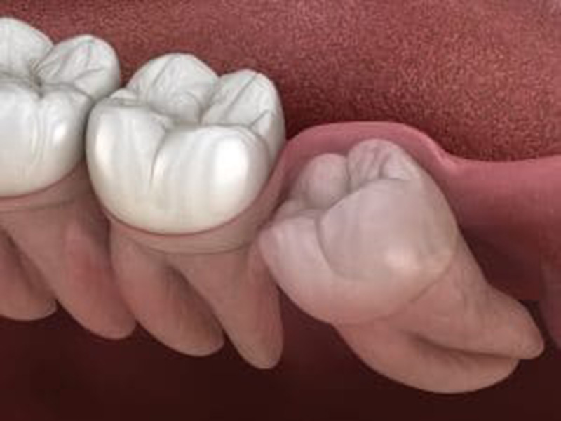 When Do Smiles Benefit From Tooth Extraction? featured image