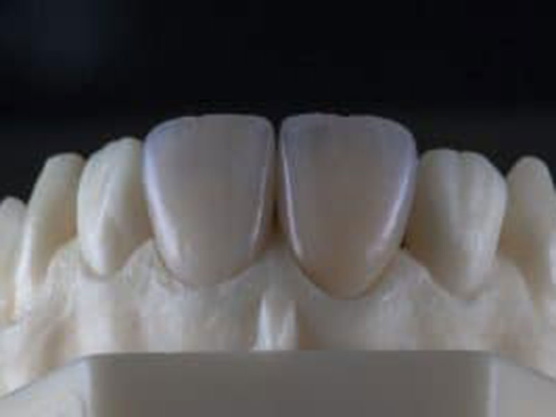 Do You Want a New Smile? Consider Porcelain Veneers! featured image