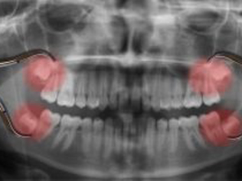 Don’t Let Wisdom Teeth Change Your Smile featured image