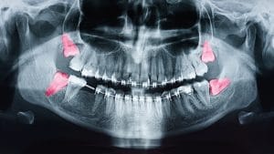 x-ray of teeth