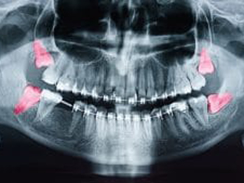 Take Advantage of Our Wisdom Tooth Special featured image