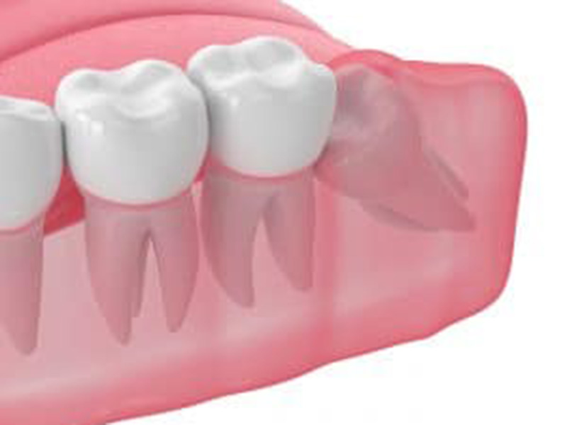 Should My Wisdom Teeth Concern Me? featured image
