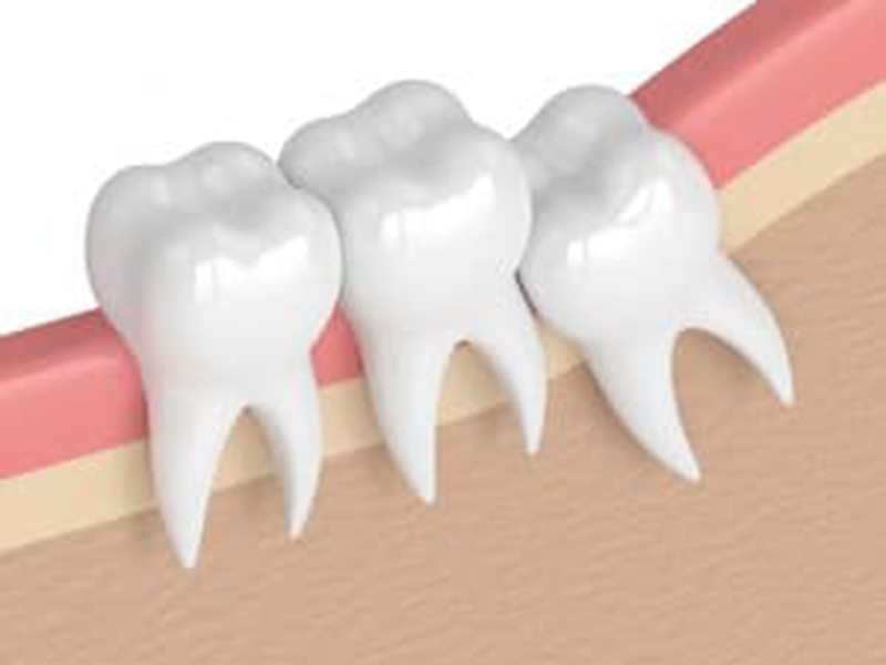 How Do We Remove Wisdom Teeth? featured image