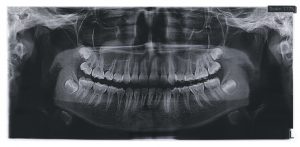 teeth e-xray