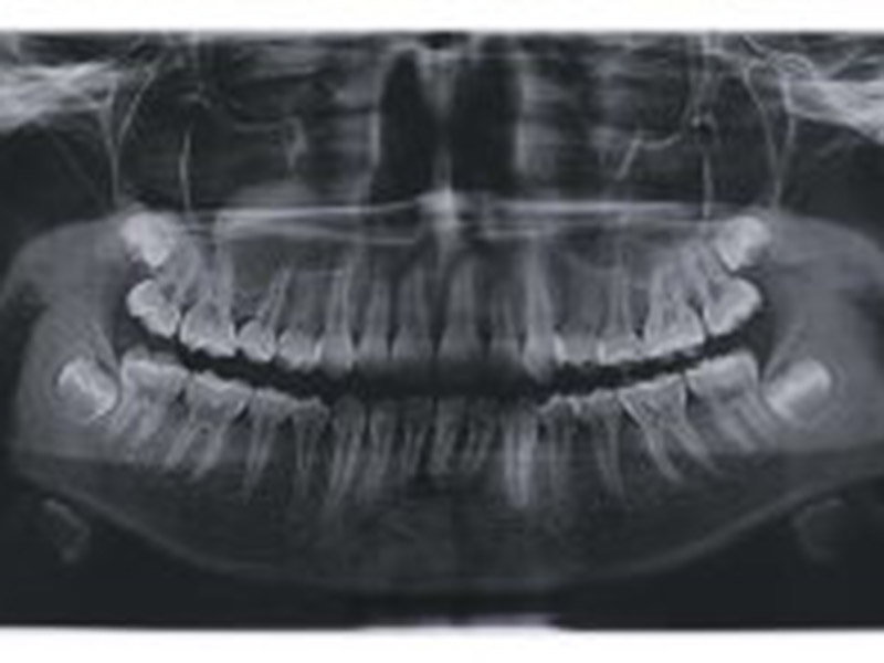 Why Do Wisdom Teeth Need to Be Removed? featured image
