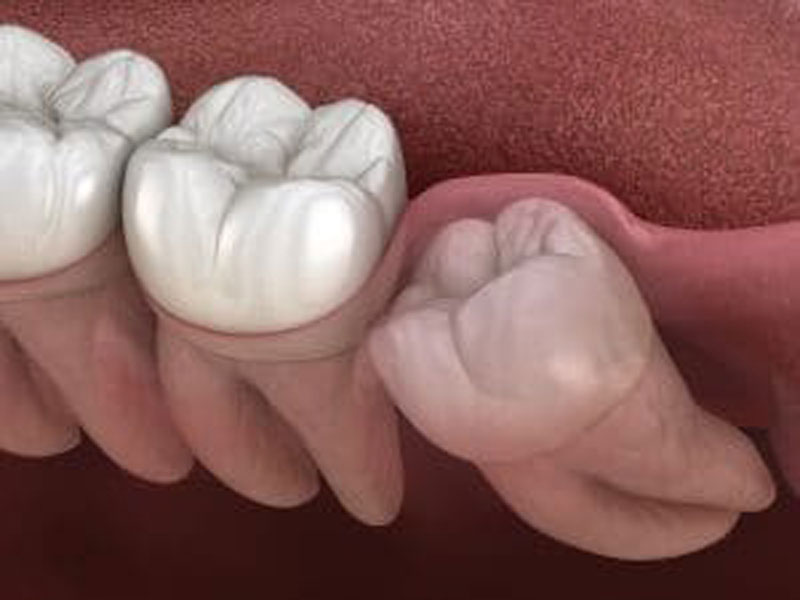 Should Your Wisdom Teeth Be Extracted? featured image