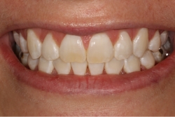 patient's front teeth after a bonding and contouring treatment