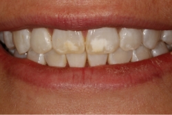 patient's front teeth before a bonding and contouring treatment