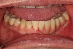 patient after dental implants and missing section of jaw is gone