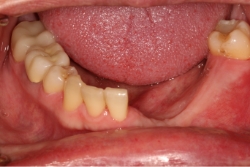 patient before dental implants with missing section of lower jaw