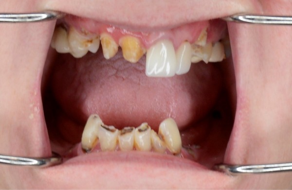 patient's decayed and rotting teeth