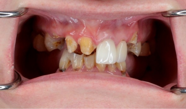 patient's decayed and rotting teeth