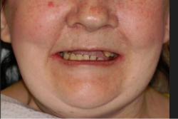 patient's smile before dentures