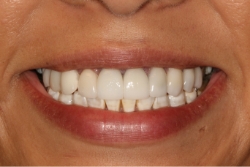 A patient's smile after veneers