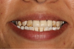 A patient's smile before veneers