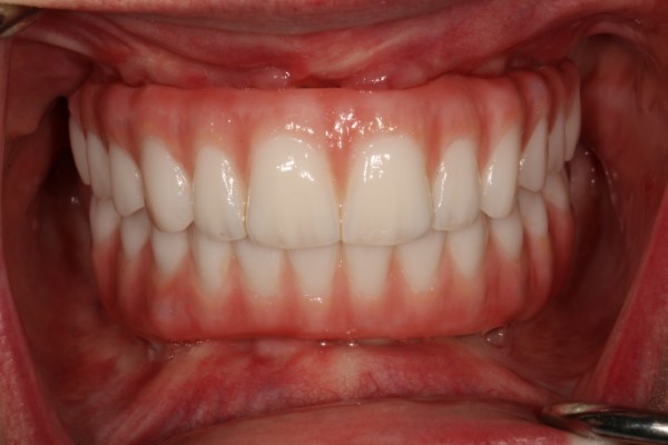 custom-fitted modern dental bridge in patient's mouth